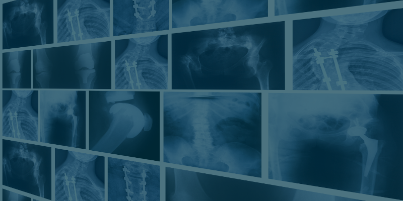 Missed fracture blog image x-ray screens